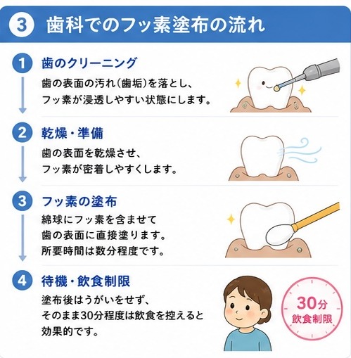 ③歯科でのフッ素塗布の流れ