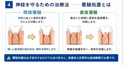 ④神経を守るための治療法・覆髄処置とは