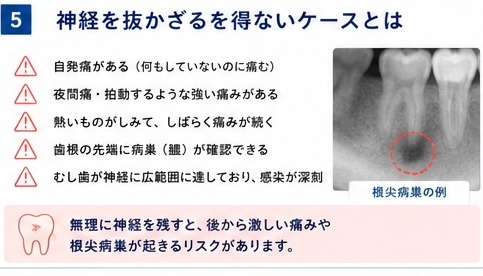 ⑤神経を抜かざるを得ないケースとは