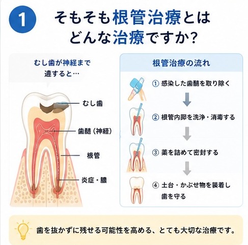 根管治療とはどんな治療ですか